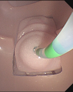 Image of bile duct cannulation