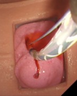 Image of reproduction of bleeding complications