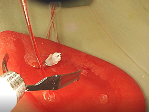 止血クリップで潰瘍を把持している画像