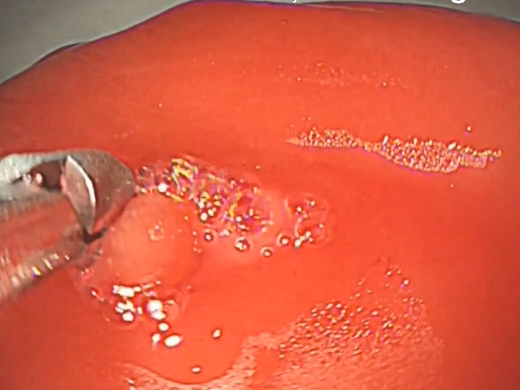 止血鉗子で潰瘍を把持・通電している画像