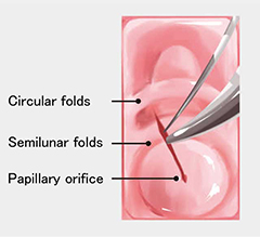 Illustrations of circular fold, hooding fold, and papillary orifice